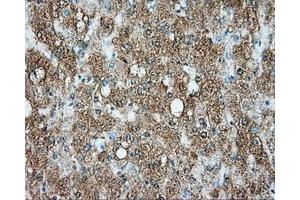 Immunohistochemical staining of paraffin-embedded Carcinoma of liver tissue using anti-SRR mouse monoclonal antibody. (SRR Antikörper)