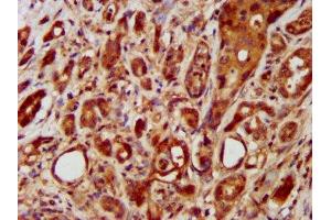 IHC image of ABIN7158186 diluted at 1:400 and staining in paraffin-embedded human pancreatic cancer performed on a Leica BondTM system. (LRRC45 Antikörper  (AA 222-357))