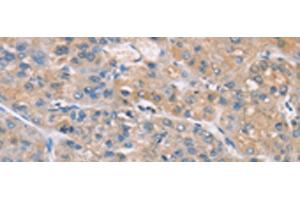 Immunohistochemistry of paraffin-embedded Human liver cancer tissue using ZADH2 Polyclonal Antibody at dilution of 1:100(x200) (ZADH2 Antikörper)