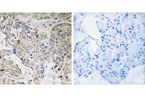 Peptide - +Immunohistochemistry analysis of paraffin-embedded human breast carcinoma tissue using CEP41 antibody. (CEP41 Antikörper)
