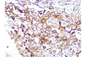 Immunohistochemistry of paraffin-embedded human esophageal cancer using Caveolin-2 Rabbit mAb (ABIN7266155) at dilution of 1:100 (40x lens). (Caveolin 2 Antikörper)