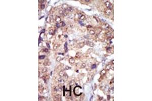 Immunohistochemistry (Paraffin-embedded Sections) (IHC (p)) image for anti-V-Yes-1 Yamaguchi Sarcoma Viral Related Oncogene Homolog (LYN) (AA 32-62), (N-Term) antibody (ABIN392102)