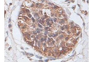Immunohistochemical staining of formalin-fixed paraffin-embedded human prostate carcinoma tissue showing cytoplasmic and membrane staining with PTP4A2 polyclonal antibody  at 1 : 100 dilution. (PTP4A2 Antikörper  (AA 2-167))