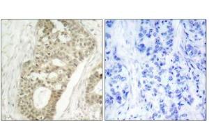 Immunohistochemical analysis of paraffin-embedded human breast carcinoma tissue, using PKC delta (phospho-Ser645) antibody. (PKC delta Antikörper  (pSer645))