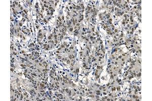 ABIN7095146 and ABIN7099202 at 1/100 staining human colorectal cancer by IHC-P. (THO Complex 2 Antikörper)