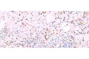 Immunohistochemistry of paraffin-embedded Human cervical cancer tissue using KATNAL1 Polyclonal Antibody at dilution of 1:95(x200) (KATNAL1 Antikörper)