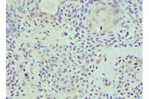Immunohistochemistry of paraffin-embedded human breast cancer using ABIN7155290 at dilution of 1:100 (HAT1 Antikörper  (Catalytic Subunit))