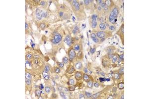 Immunohistochemistry of paraffin-embedded human esophageal cancer using PPP1CB antibody.