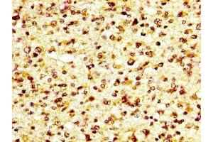 IHC image of ABIN7163593 diluted at 1:600 and staining in paraffin-embedded human glioma performed on a Leica BondTM system. (GP6 Antikörper  (AA 115-265))
