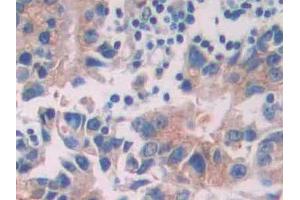 DAB staining on IHC-P; Samples: Human Prostate cancer Tissue (Tyrosine Protein Kinase 7 (AA 853-1070) Antikörper)