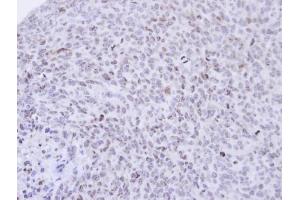 IHC-P Image Immunohistochemical analysis of paraffin-embedded H1299 xenograft , using PCNP, antibody at 1:500 dilution. (PCNP Antikörper  (N-Term))