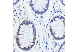 Immunohistochemistry of paraffin-embedded human colon carcinoma using TRIM16 antibody (ABIN7270978) at dilution of 1:100 (40x lens). (TRIM16 Antikörper  (AA 1-210))