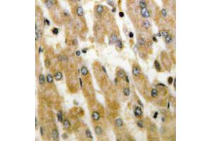 Immunohistochemical analysis of DUSP1/4 staining in human liver cancer formalin fixed paraffin embedded tissue section. (MKP-1/2 Antikörper  (C-Term))