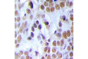 Immunohistochemical analysis of MCM3 staining in human breast cancer formalin fixed paraffin embedded tissue section. (MCM3 Antikörper)