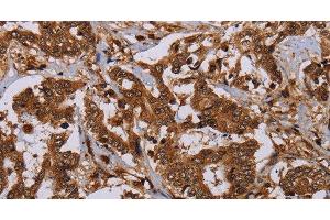 Immunohistochemistry of paraffin-embedded Human liver cancer using MOB1A Polyclonal Antibody at dilution of 1:30 (MOB1A Antikörper)