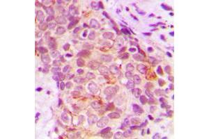 Immunohistochemical analysis of MARK3 staining in human breast cancer formalin fixed paraffin embedded tissue section. (MARK3 Antikörper  (N-Term))