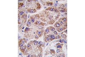 Formalin-fixed and paraffin-embedded human hepatocarcinoma tissue reacted with FDPS antibody (Center ) (ABIN389054 and ABIN2839263) , which was peroxidase-conjugated to the secondary antibody, followed by DAB staining.