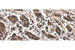 Immunohistochemistry of paraffin-embedded Human breast cancer tissue using ARPC1B Polyclonal Antibody at dilution of 1:65(x200) (ARPC1B Antikörper)