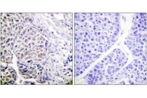 Immunohistochemistry analysis of paraffin-embedded human liver carcinoma, using AurB (Phospho-Tyr12) Antibody. (Aurora Kinase B Antikörper  (pTyr12))