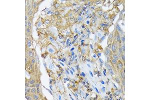 Immunohistochemistry of paraffin-embedded human lung cancer using R Rabbit mAb (ABIN7269840) at dilution of 1:100 (40x lens). (RALBP1 Antikörper)