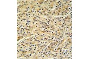 Immunohistochemistry analysis in formalin fixed and paraffin embedded prostate carcinoma reacted with HOXA3 / HOX1E Antibody (C-term) Cat. (HOXA3 Antikörper  (C-Term))