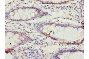Immunohistochemistry of paraffin-embedded human colon cancer using ABIN7171939 at dilution of 1:100 (TTC38 Antikörper  (AA 2-200))