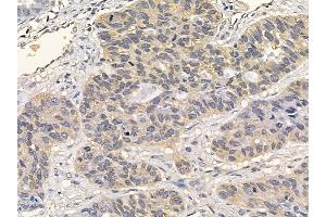 FGFR3 Mouse Monoclonal Antibody at 1/100 staining human lung cancer and adjacent non-tumor tissue by IHC-P. (FGFR3 Antikörper  (C-Term))
