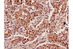Immunohistochemistry of paraffin-embedded human lung cancer using ABIN7156215 at dilution of 1:100 (INMT Antikörper  (AA 1-263))