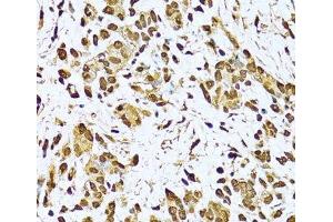 Immunohistochemistry of paraffin-embedded Human gastric cancer using KU70 Polyclonal Antibody at dilution of 1:100 (40x lens).