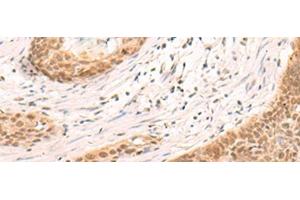 Immunohistochemistry of paraffin-embedded Human esophagus cancer tissue using SIX6 Polyclonal Antibody at dilution of 1:30(x200) (SIX Homeobox 6 Antikörper)