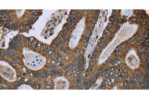 Immunohistochemistry of paraffin-embedded Human colon cancer using GOT2 Polyclonal Antibody at dilution of 1:50 (GOT2 Antikörper)