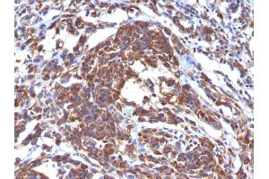 Formalin-fixed, paraffin-embedded human Melanoma stained with Vimentin Monoclonal Antibody (LN-6). (Vimentin Antikörper)