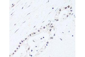 Immunohistochemistry of paraffin-embedded Human gastric cancer using BRIX1 Polyclonal Antibody at dilution of 1:100 (40x lens). (BRIX1 Antikörper)