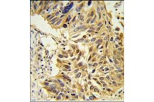 Immunohistochemistry analysis in Formalin Fixed, Paraffin Embedded lung carcinoma stained with SDR Antibody (Center) followed by peroxidase conjugation of the secondary antibody and DAB staining. (SDPR Antikörper  (Middle Region))