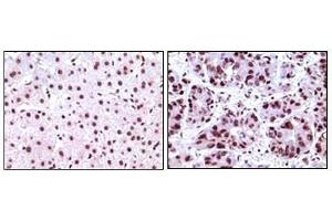 Immunohistochemical analysis of paraffin-embedded human liver carcinoma tissues, showing nuclear localization using NPM antibody with DAB staining. (NPM1 Antikörper)
