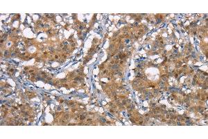 Immunohistochemistry of paraffin-embedded Human gastic cancer using CDC25A Polyclonal Antibody at dilution of 1:50 (CDC25A Antikörper)