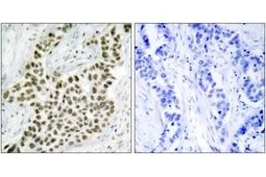 Immunohistochemistry analysis of paraffin-embedded human breast carcinoma tissue, using Histone H2A. (H2AFX Antikörper  (AA 94-143))