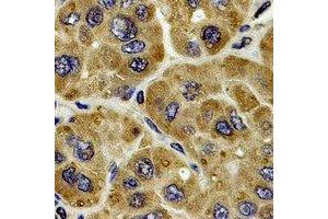 Immunohistochemical analysis of CES1 staining in human liver cancer formalin fixed paraffin embedded tissue section.