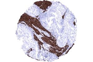 Stomach Gastric adenocarcinoma invading desmin positive smooth muscle fibres (Rekombinanter Desmin Antikörper)