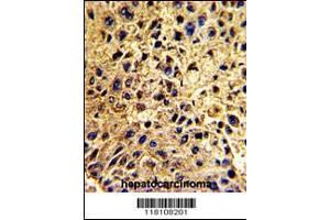 Formalin-fixed and paraffin-embedded human hepatocarcinoma with , which was peroxidase-conjugated to the secondary antibody, followed by DAB staining. (NUP62 Antikörper  (C-Term))