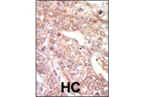 Formalin-fixed and paraffin-embedded human cancer tissue reacted with the primary antibody, which was peroxidase-conjugated to the secondary antibody, followed by AEC staining. (EPHA1 Antikörper  (N-Term))