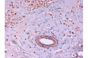 Immunohistochemistry of Rat monoclonal anti AKT2 unconjugated Antibody in human breast carcinoma. (AKT2 Antikörper  (Internal Region) (FITC))