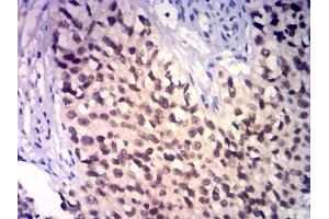 Immunohistochemical analysis of paraffin-embedded bladder cancer tissues using GATA3 mouse mAb with DAB staining. (GATA3 Antikörper)
