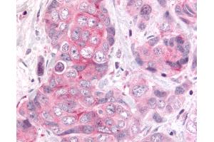 Anti-DUSP22 / JSP 1 antibody IHC of human Colon, Carcinoma. (DUSP22 Antikörper  (Internal Region))