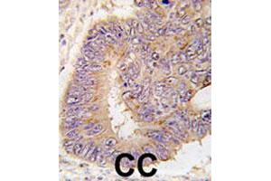 Formalin-fixed and paraffin-embedded human colon carcinoma tissue reacted with PDE8A polyclonal antibody  , which was peroxidase-conjugated to the secondary antibody, followed by DAB staining. (PDE8A Antikörper  (Leu572))