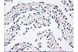Immunohistochemical staining of paraffin-embedded Adenocarcinoma of breast tissue using anti-PLK1 mouse monoclonal antibody. (PLK1 Antikörper)