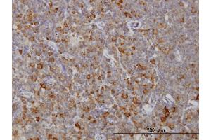 Immunoperoxidase of monoclonal antibody to RAB8A on formalin-fixed paraffin-embedded human lymphoma. (RAB8A Antikörper  (AA 108-207))