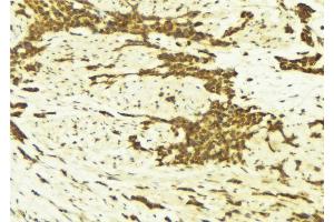 ABIN6269179 at 1/100 staining Human breast cancer tissue by IHC-P.