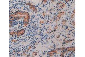 IHC-P analysis of Human Prostate Gland Cancer Tissue, with DAB staining. (Prolactin Receptor Antikörper  (AA 25-234))