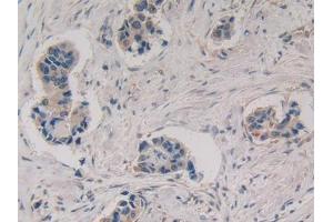 DAB staining on IHC-P; Samples: Human Breast cancer Tissue (MMP3 Antikörper  (AA 363-477))